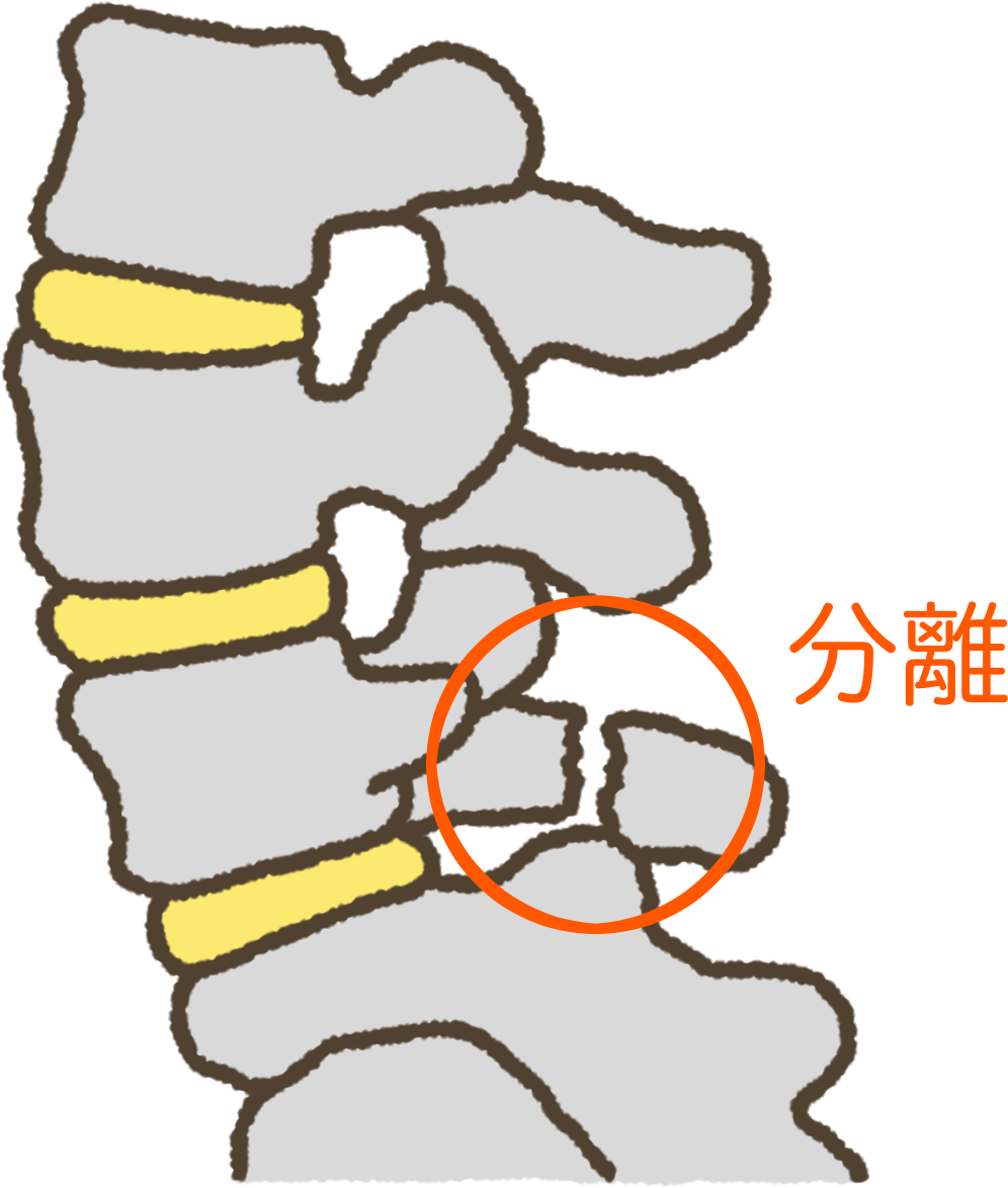 腰椎分離症