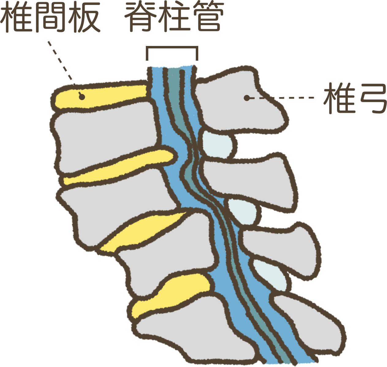 脊柱管狭窄症の状態 脊柱管狭窄症の状態