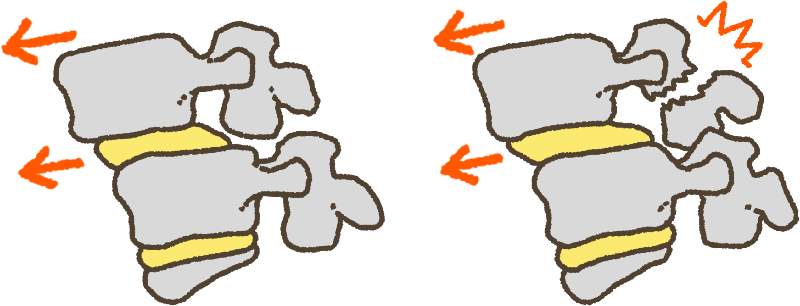 変形すべり症（左）と分離すべり症（右）